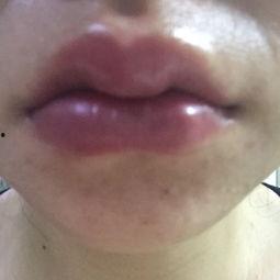 嘴唇打玻尿酸图片,重塑唇部轮廓，展现迷人微笑